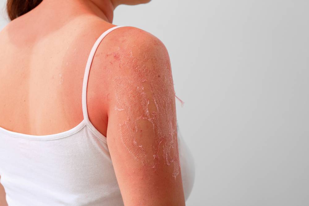 Ako si chrániť pokožku pred slnečným žiarením